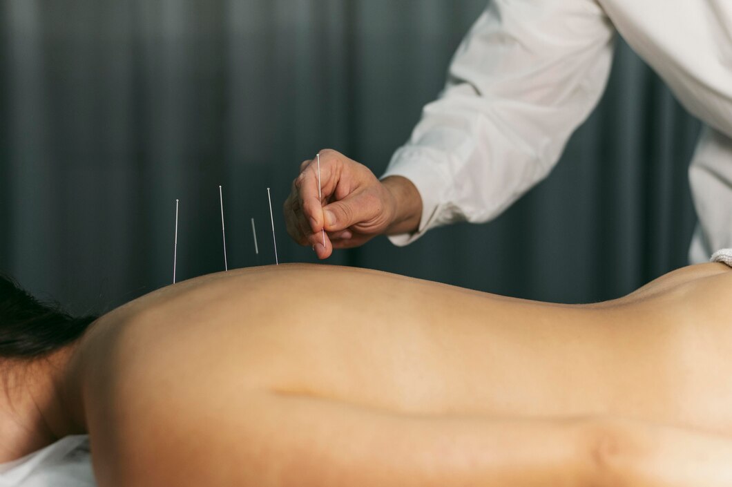 Czy akupunktura naprawdę działa? Rozbijamy mity i prawdy